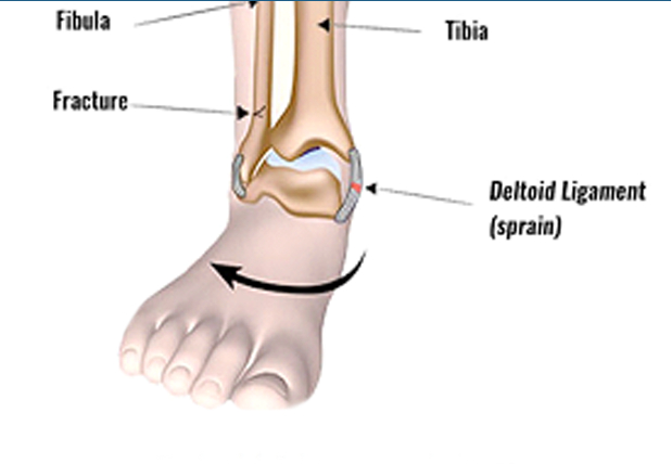 Before Deltoid Ligament Treatment